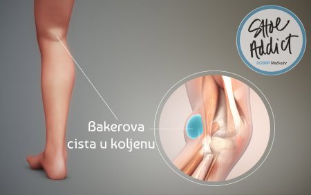 Bakerova cista: Sve što trebate znati